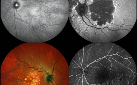 SPECTRALIS Multimodal Imaging