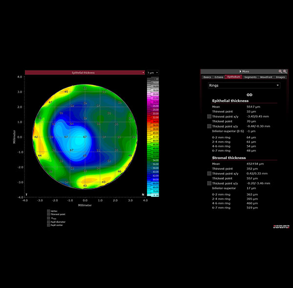 Epithelium Thickness Module